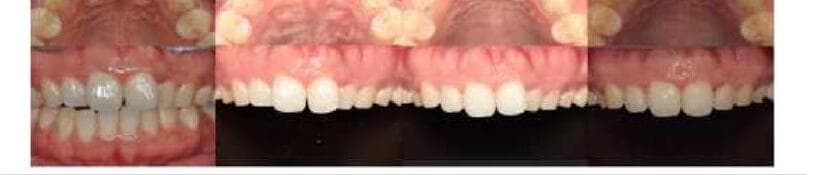 이와이어라이너 제품 이미지